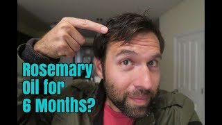 Rosemary Oil for My Hair Loss Photos Before and After 6 Month Experiment [upl. by Eatnuahs]