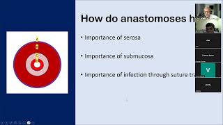 Anastomotic leak group discussion lakshman 231005 [upl. by Palua]