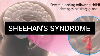 SHEEHANS SYNDROME TAMIL [upl. by Heim]