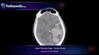 Stroke Lobar haemorrhage  radiology video tutorial MRI CT [upl. by Michelle]