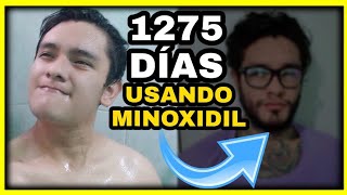 3 AÑOS 6 MESES Usando ¡MINOXIDIL 👨🏻  Mis ¡Avances Épicos De “Lampiño a Barbón” ¿ME SALIO BARBA [upl. by Aivul]