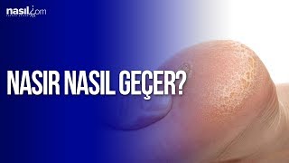 Nasır İçin Doğal Çözümler  Sağlık  Nasilcom [upl. by Ri]