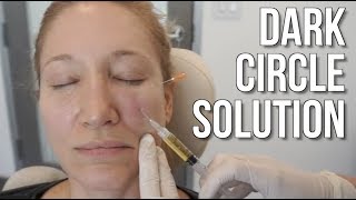 Dark Circle Treatment With PRP Platelet Rich Plasma [upl. by Lladnyk]