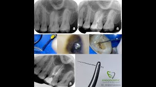 How to Break and Remove an Endodontic File  Dr Andrei Ionescu [upl. by Attekram]