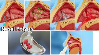 Nasal polyps treatment and surgery 3d medical animationDandelion Team nasalpolyp noose [upl. by Dekow897]