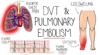 Deep Vein Thrombosis DVT amp Pulmonary Embolism Explained [upl. by Xena]