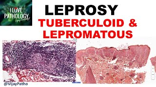 LEPROSY etiopathogenesis classification Tuberculoid amp lepromatous leprosy [upl. by Renfred816]