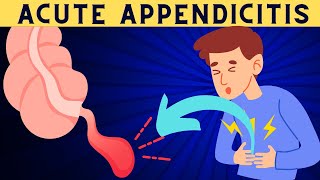 Acute Appendicitis Signs And Symptoms Risk Factors Diagnosis And Treatment [upl. by Festus]