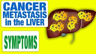 Cancer Metastasis in the Liver  All Symptoms [upl. by Lasyrc]