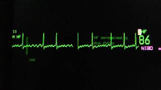 atrial fibrillation with adequate rate control on an ECG heart monitor [upl. by Haim]