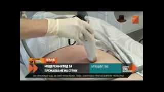 Как се махат стрии  Stretch marks striae removing treatment in Hill Clinic Sofia Bulgaria [upl. by Ahkos851]