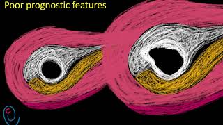 Early pregnancy ultrasound explained  GS  YS and FP [upl. by Ophelia]