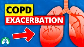 COPD Exacerbation  What is it Acute Symptoms  Definition [upl. by Nilyak]