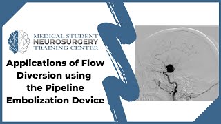 Applications of Flow Diversion using the Pipeline Embolization Device [upl. by Nnahaid872]