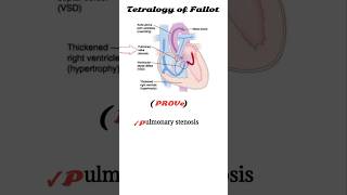 tetralogy of fallot mnemonic  TOF [upl. by Hildy]