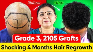 Hair Transplant in Jaipur  Hair Transplant Results  Hair Transplant Cost [upl. by Bigler]