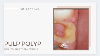 PULP POLYP  CHRONIC HYPERPLASTIC PULPITIS [upl. by Og605]