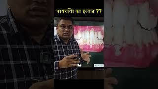 पायरिया का इलाज  gumdisease shorts [upl. by Aluin]