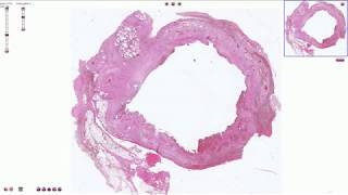 Chronic Cholecystitis  Histopathology [upl. by Yelsna]