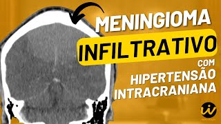 MENINGIOMA INFILTRATIVO com Sinais de HIPERTENSÃO INTRACRANIANA [upl. by Ziul948]