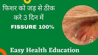 Fissure Treatment in home Hindi  फिशर को घर बैठे कैसे ठीक करे 100 Fissure home remedies [upl. by Nyrual924]