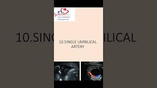 Single umbilical artery  What should we do SUA [upl. by Michigan]