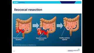 Crohns Disease Nursing  Crohns Symptoms Pathophysiology Treatment Diet NCLEX [upl. by Ycniuqed]