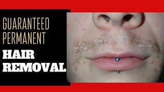 ELECTROLYSIS UPPER LIP HAIR REMOVAL TRANSGENDER Woman [upl. by Ettore]