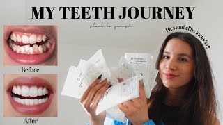 MY TEETH JOURNEY  Invisalign Composite Bonding Whitening  Answering All Your Questions [upl. by Lamont39]