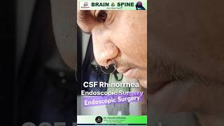 CSF rhinorrhea endoscopicspinesurgery shortvideo pune hospital neurosurgeon in [upl. by Ardried421]