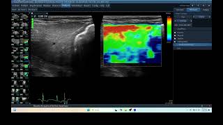 IQ 277 LIVER ELASTOGRAPHY HEPATOMA ECHOPAC ANALYSIS ULTRASOUND [upl. by Hogue]