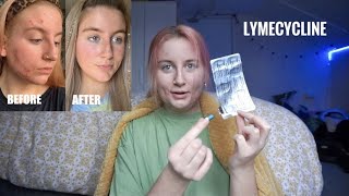 my acne journey  lymecycline [upl. by Nyrrat37]