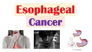 Esophageal Cancer  Risk Factors Pathogenesis Signs and Symptoms Diagnosis Treatment [upl. by Enilamme]