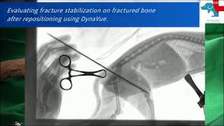 DynaVueNon incision Pinning repair femoral fracture [upl. by Eixel]