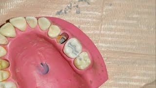 Amalgam restoration for maxillary first molar [upl. by Annayad381]