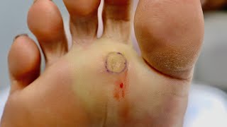 Surgically removing a PAINFUL FOOT CORN [upl. by Amati]