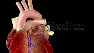 Atrial Fibrillation Triggers  Animated Atlas of Atrial Fibrillation [upl. by Farrel]