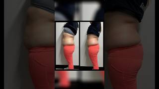 Results of cryoslimming cryotherapy cryoslimming cryotherapist [upl. by Nirtak]