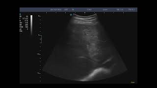 Portal vein thrombosis thrombus liver cirrhosis abdomen Ultrasound [upl. by Zurheide]