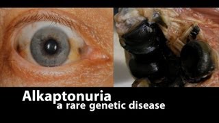 Alkaptonuria a rare genetic disease [upl. by Nnaeinahpets656]