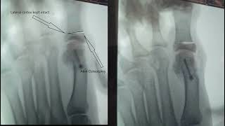 Demonstrating The Chevron amp Akin Osteotomies Under Fluoroscopy [upl. by Athalla422]