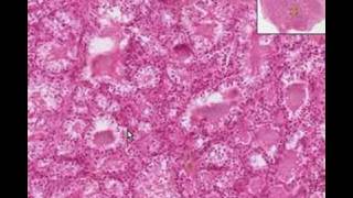 Histopathology ThyroidGraves Disease [upl. by Amri]