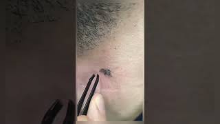 ingrown hair removal 😌 ENJOY [upl. by Gulick]