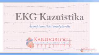 Kardioblog  EKG Kazuistika Asymptomatická bradykardie [upl. by Rana772]