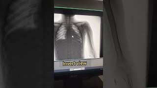 Xray Pick line  Xray Procedure radiography xray anatomy babyshorts trending viralviewsct [upl. by Chicoine]