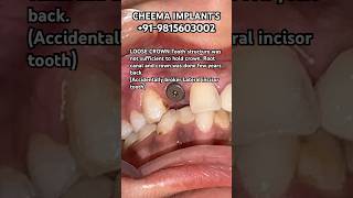 Front teeth Incisor root canal loose crown extraction procedure implant placed amp zirconia tooth [upl. by Allenad]