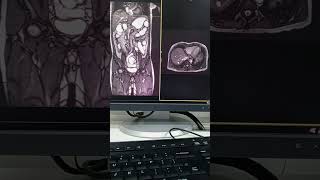 Mri enterography first time nakagawa nito [upl. by Anna]