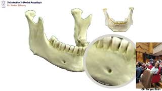 10 Mental nerve block [upl. by Rednal]