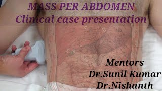 MASS PER ABDOMEN Clinical case presentation [upl. by Hagood]