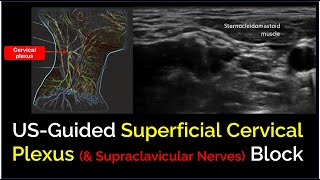 Superficial Cervical Plexus Block  a quotHowToquot Guide [upl. by Stahl]